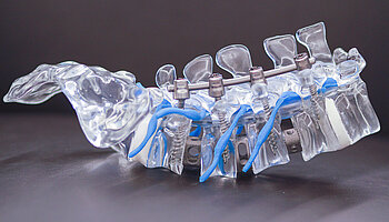 Detailaufnahme einer stabilisierten Wirbelsäule mit Implantaten zur Wirbelsäulenversteifung.