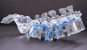 Detailaufnahme einer stabilisierten Wirbelsäule mit Implantaten zur Wirbelsäulenversteifung.