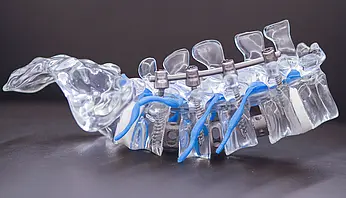 Detailaufnahme einer stabilisierten Wirbelsäule mit Implantaten zur Wirbelsäulenversteifung.